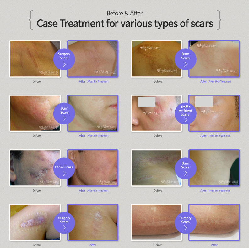 Results for Scar Removal Treatments in Seoul Expat Health Seoul